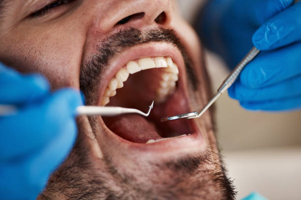 Best Emergency Wisdom Teeth Removal in Altamont, NY